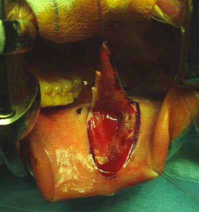 Stenosi uretrale - ricotrauzone dalla mucosa buccale