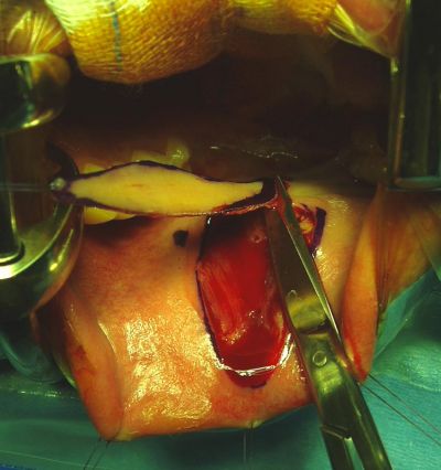 Stenosi uretrale - ricotrauzone dalla mucosa buccale